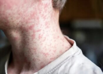 México lidera brotes de sarampión en América con más de 11.200 casos